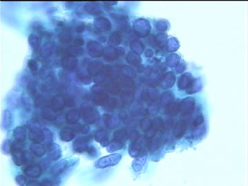 宫颈液基细胞学病例图4