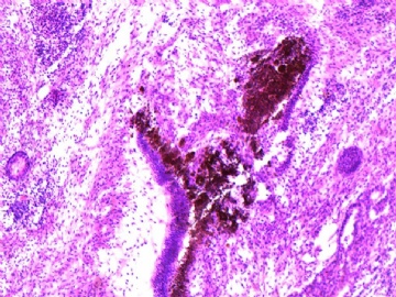 右侧卵巢，未成熟畸胎瘤图4