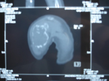 肱骨肿瘤图1