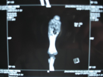 肱骨肿瘤图3