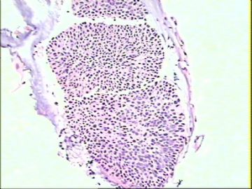 宫颈活检1例（P10074） (上传宫颈锥切6-7点组织学图像 2010-03-31）图1