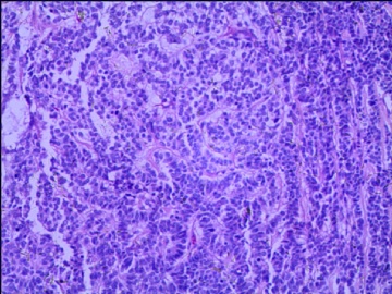 左侧腘窝肿瘤--这是一例真正经典型“恶性”，满足本肿瘤恶性的所有条件。图3