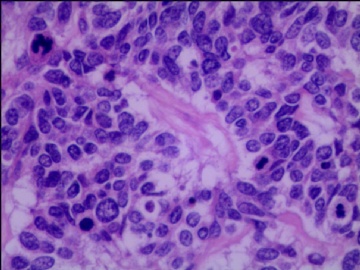 左侧腘窝肿瘤--这是一例真正经典型“恶性”，满足本肿瘤恶性的所有条件。图4