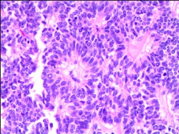 左侧腘窝肿瘤--这是一例真正经典型“恶性”，满足本肿瘤恶性的所有条件。图5