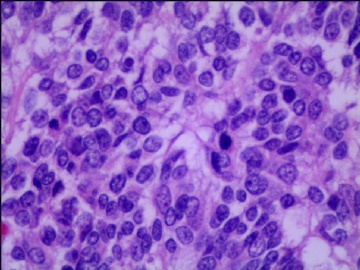 左侧腘窝肿瘤--这是一例真正经典型“恶性”，满足本肿瘤恶性的所有条件。图6