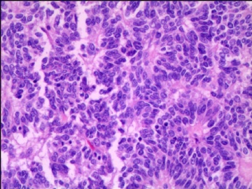 左侧腘窝肿瘤--这是一例真正经典型“恶性”，满足本肿瘤恶性的所有条件。图7