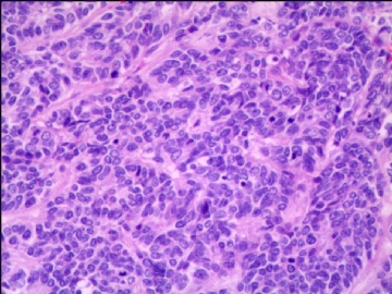 左侧腘窝肿瘤--这是一例真正经典型“恶性”，满足本肿瘤恶性的所有条件。图8