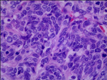 左侧腘窝肿瘤--这是一例真正经典型“恶性”，满足本肿瘤恶性的所有条件。图9