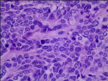 左侧腘窝肿瘤--这是一例真正经典型“恶性”，满足本肿瘤恶性的所有条件。图10
