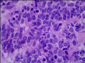 左侧腘窝肿瘤--这是一例真正经典型“恶性”，满足本肿瘤恶性的所有条件。图11