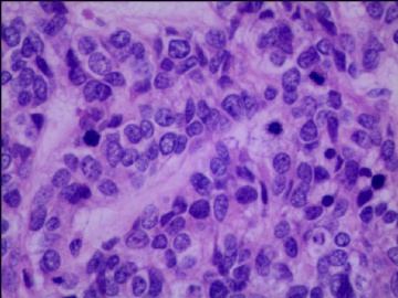 左侧腘窝肿瘤--这是一例真正经典型“恶性”，满足本肿瘤恶性的所有条件。图13