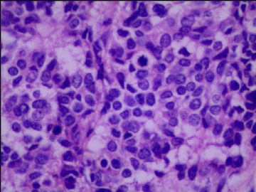 左侧腘窝肿瘤--这是一例真正经典型“恶性”，满足本肿瘤恶性的所有条件。图15