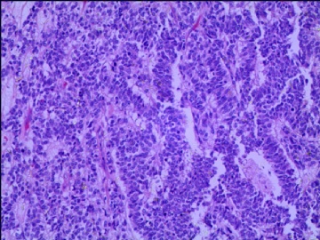 左侧腘窝肿瘤--这是一例真正经典型“恶性”，满足本肿瘤恶性的所有条件。图16