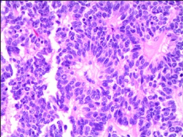 左侧腘窝肿瘤--这是一例真正经典型“恶性”，满足本肿瘤恶性的所有条件。图17