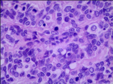 左侧腘窝肿瘤--这是一例真正经典型“恶性”，满足本肿瘤恶性的所有条件。图18