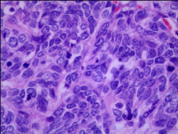 左侧腘窝肿瘤--这是一例真正经典型“恶性”，满足本肿瘤恶性的所有条件。图19