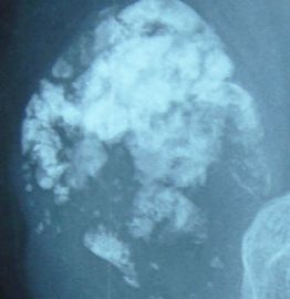 左侧腘窝肿瘤--这是一例真正经典型“恶性”，满足本肿瘤恶性的所有条件。图20