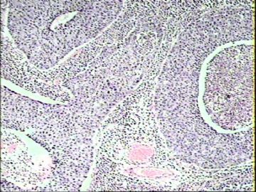 阴道脱出新生物1例（T1007）2010-03-25图2