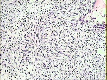 阴道脱出新生物1例（T1007）2010-03-25图6