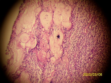 卵巢肿物图1