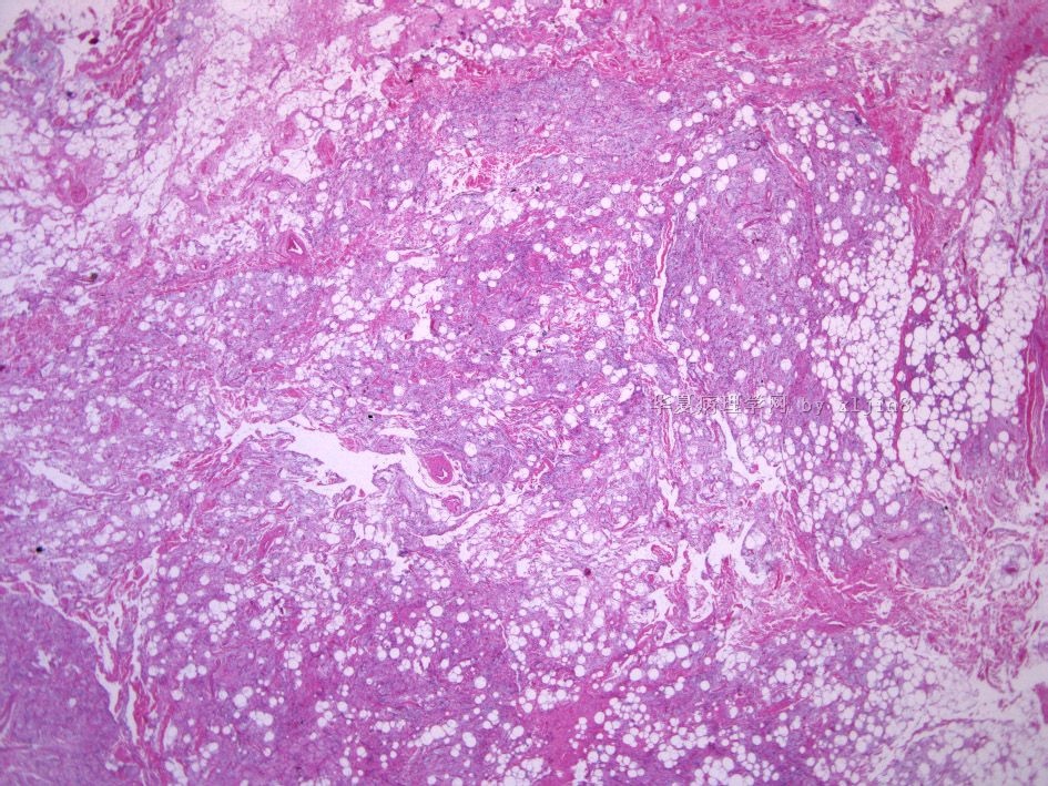 男/56岁 颈项部肿块 梭形细胞脂肪瘤 or 树突状纤维粘液脂肪瘤？图1