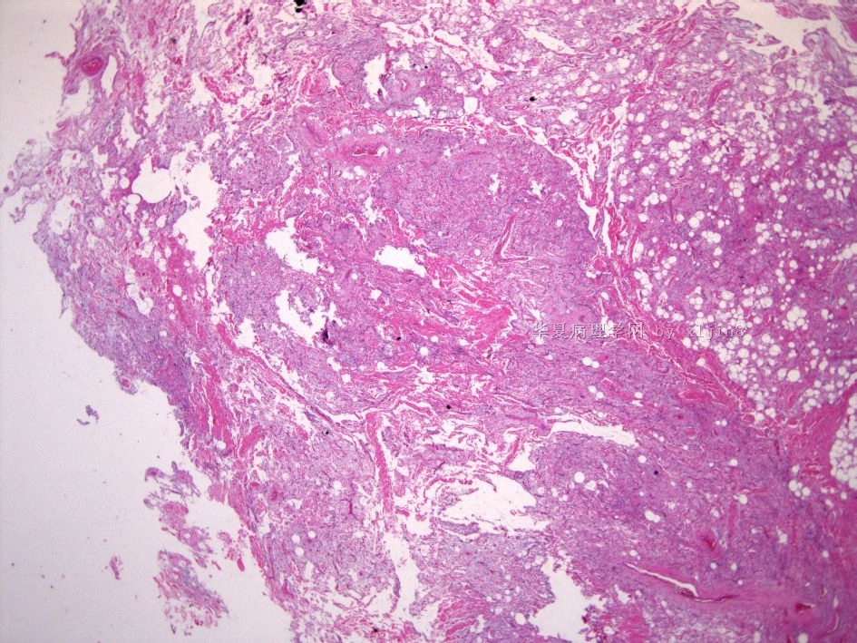 男/56岁 颈项部肿块 梭形细胞脂肪瘤 or 树突状纤维粘液脂肪瘤？图2