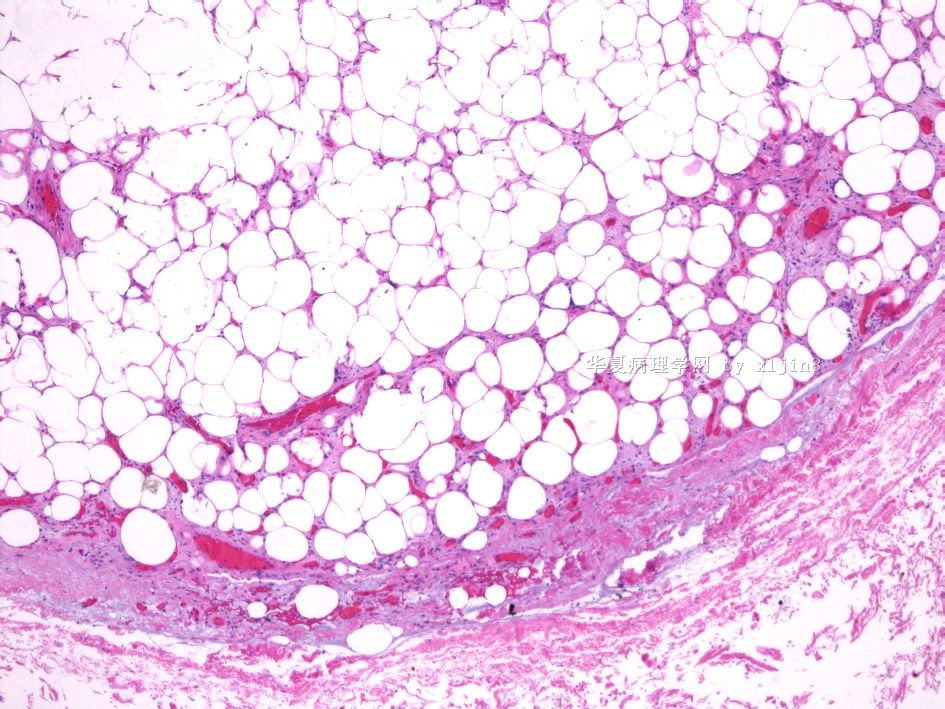 男/56岁 颈项部肿块 梭形细胞脂肪瘤 or 树突状纤维粘液脂肪瘤？图16
