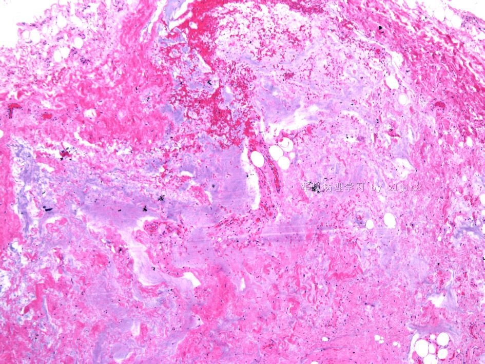 男/56岁 颈项部肿块 梭形细胞脂肪瘤 or 树突状纤维粘液脂肪瘤？图17