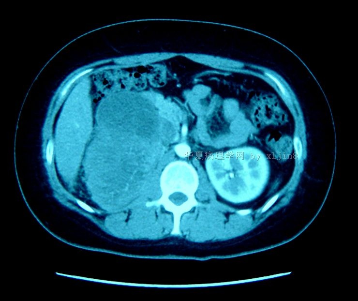 女/28岁 右肾上腺巨大肿瘤（粘液型皮质癌）图9