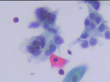 宫颈液基细胞学体检病例图1