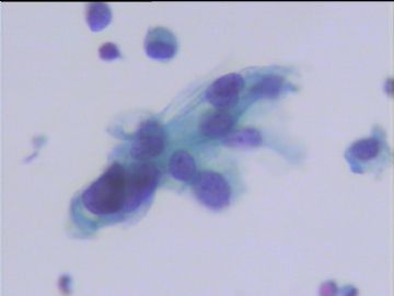 宫颈液基细胞学体检病例图2