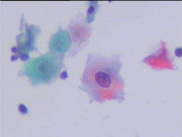 宫颈液基细胞学体检病例图5