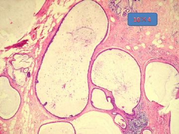 乳腺囊性病变，看看导管上皮有问题么？图3