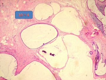 乳腺囊性病变，看看导管上皮有问题么？图4