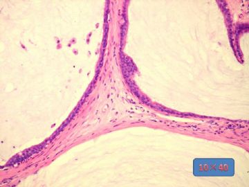 乳腺囊性病变，看看导管上皮有问题么？图13