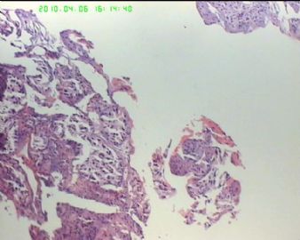 55岁 蝶窦内斜坡硬膜外质硬肿物伴骨破坏，供血丰富图5