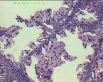 55岁 蝶窦内斜坡硬膜外质硬肿物伴骨破坏，供血丰富图11