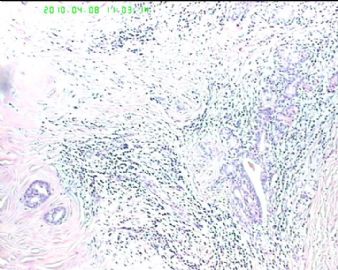 55岁右腮腺区耳后肿物1年图3