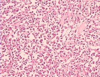 乳腺巨大肿瘤，请会诊！（附免疫组化）图4
