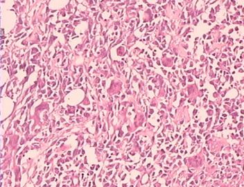 乳腺巨大肿瘤，请会诊！（附免疫组化）图6