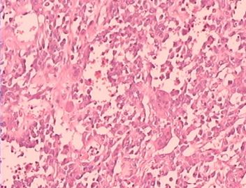 乳腺巨大肿瘤，请会诊！（附免疫组化）图9