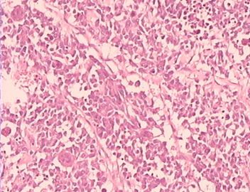 乳腺巨大肿瘤，请会诊！（附免疫组化）图13