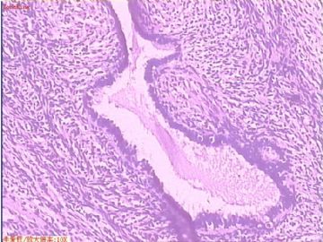 卵巢冠肿物图5