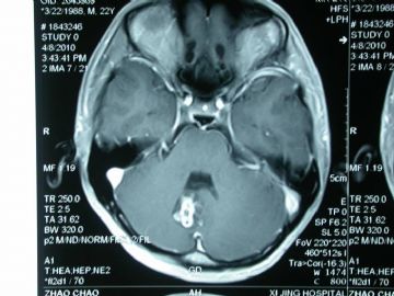 小脑肿瘤图1