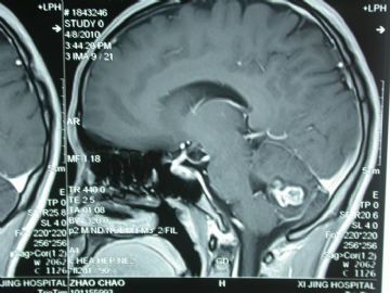 小脑肿瘤图2