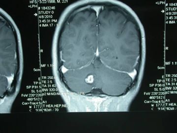 小脑肿瘤图3