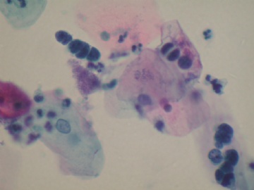 痰液基---小细胞癌图1