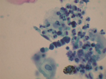 痰液基---小细胞癌图2