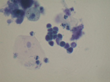 痰液基---小细胞癌图3