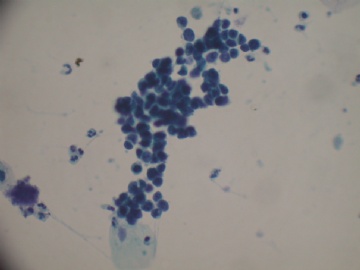 痰液基---小细胞癌图4